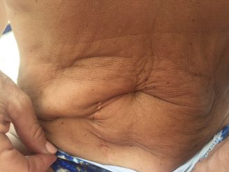 dano-erro-medico-barriga-negligencia-ganancia