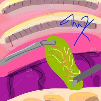 vesicula_biliar-vesicula- cirurgia- saude-sindrome do intestino_irritavel