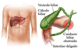 4 DICAS PARA EVITAR CIRURGIA DE VESÍCULA E PROMOVER SAÚDE DIGESTIVA